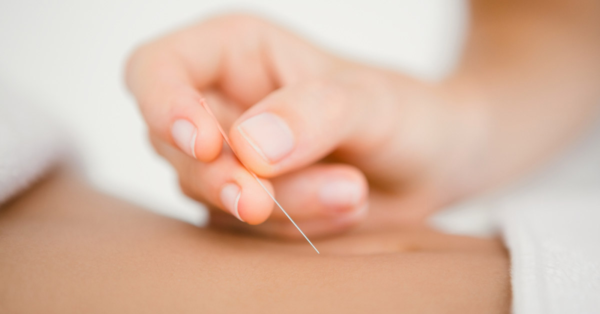 clínica de fisioterapia linares luis carlos diaz alex Punción seca