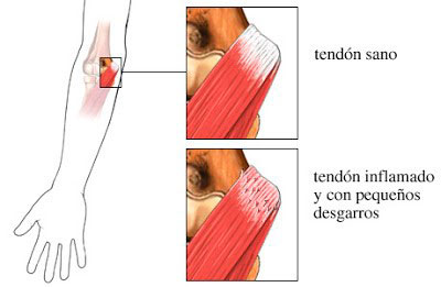 clínica de fisioterapia linares luis carlos diaz alex - TRATAMIENTO DE FISIOTERAPIA PARA LA EPICONDILITIS O CODO DE TENISTA