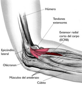 clínica de fisioterapia linares luis carlos diaz alex - TRATAMIENTO DE FISIOTERAPIA PARA LA EPICONDILITIS O CODO DE TENISTA