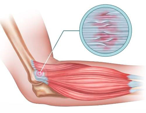 clínica de fisioterapia linares luis carlos diaz alex - TRATAMIENTO DE FISIOTERAPIA PARA LA EPICONDILITIS O CODO DE TENISTA