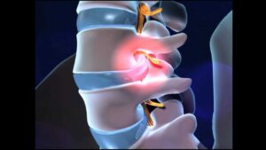 clínica de fisioterapia linares luis carlos diaz alex -TRATAMIENTO FISIOTERAPEÚTICO DE LA HERNIA DISCAL 2