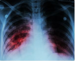 Experiencia de rehabilitación respiratoria en el tratamiento de la Enfermedad Pulmonar Intersticial en la neumonía post-COVID-19