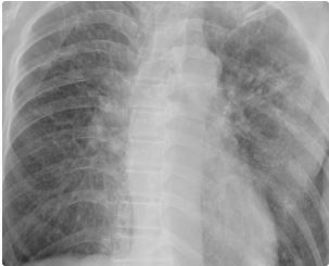 Efectos de los campos electromagnéticos pulsados de alta intensidad (HI-PEMF) en fibrosis pulmonar intersticial