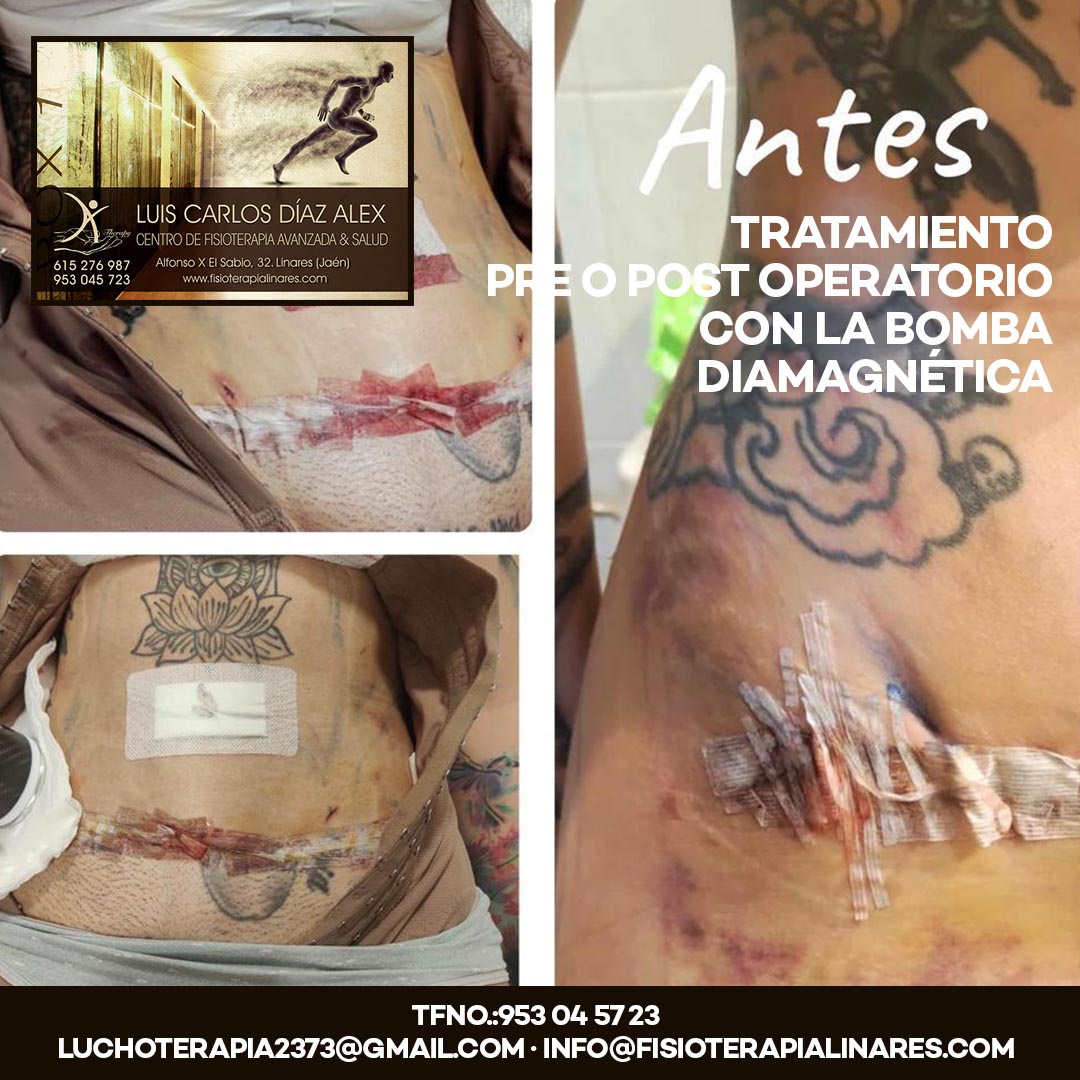 clínica de fisioterapia en Linares luis carlos diaz alex - TRATAMIENTO PRE O POST OPERATORIO CON LA BOMBA DIAMAGNÉTICA - ANTES 2