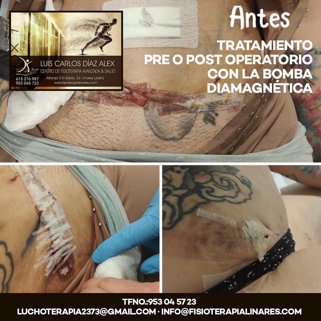 clínica de fisioterapia en Linares luis carlos diaz alex - TRATAMIENTO PRE O POST OPERATORIO CON LA BOMBA DIAMAGNÉTICA - ANTES