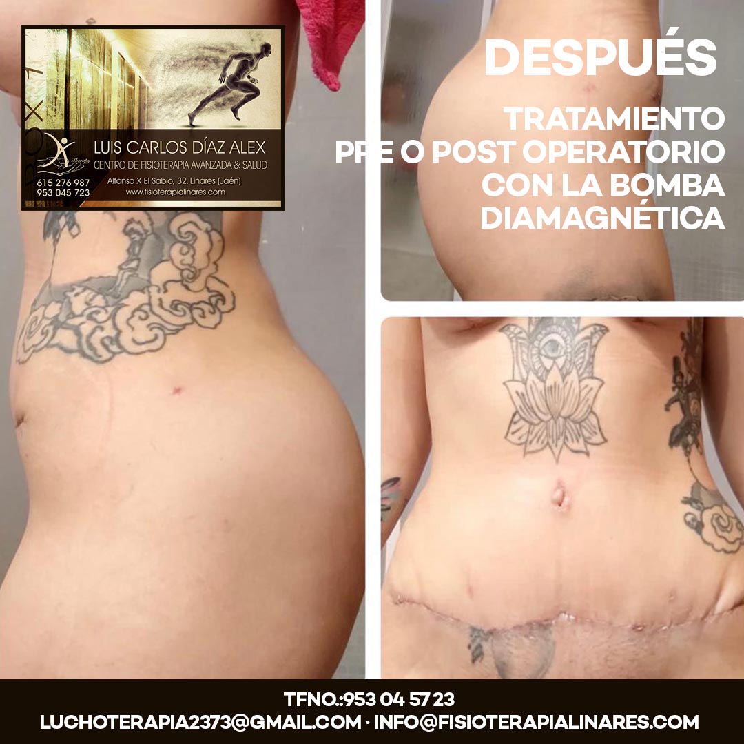 clínica de fisioterapia en Linares luis carlos diaz alex - TRATAMIENTO PRE O POST OPERATORIO CON LA BOMBA DIAMAGNÉTICA - DESPUES